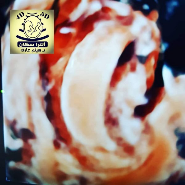 سونار ثلاثي الابعاد رحمي 3DTVUS