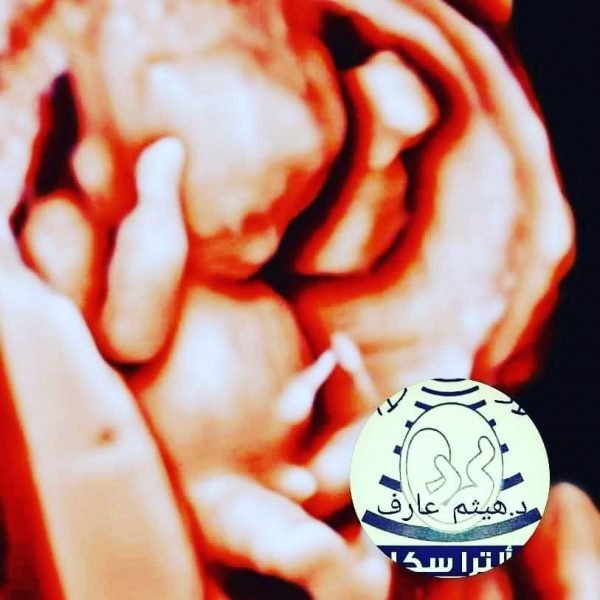 معرفه نوع الجنين مبكرا اونلاين من داخل مصر