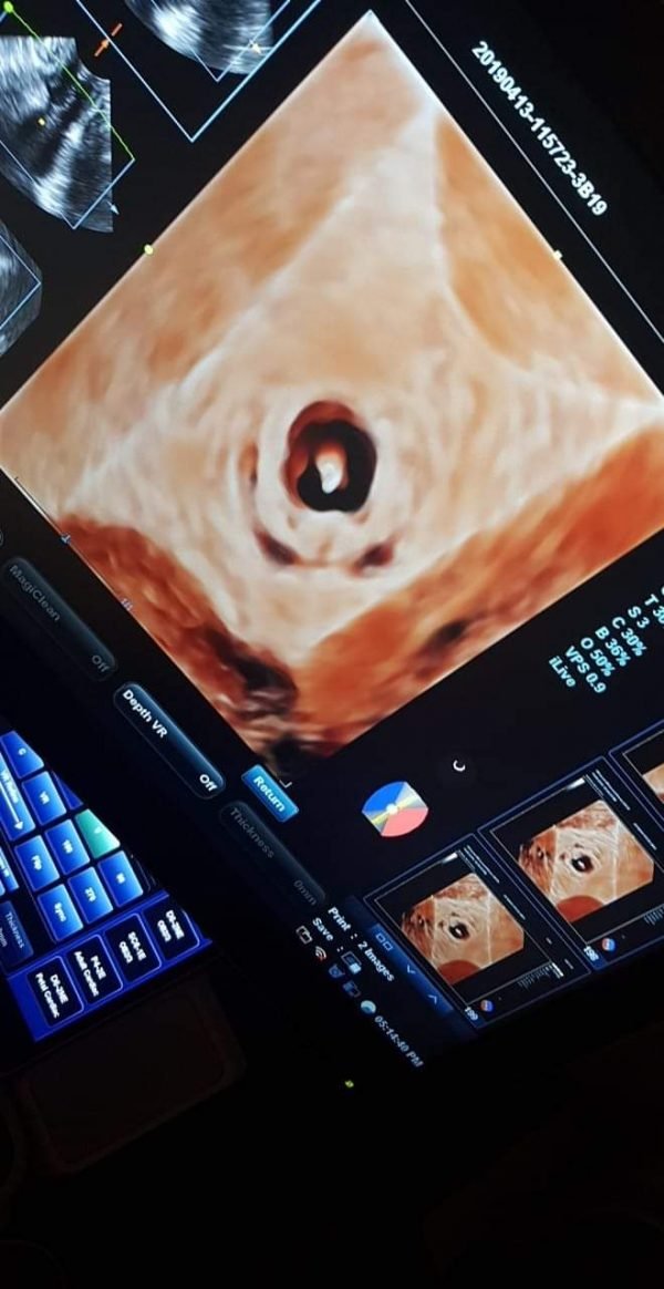 سونار  رباعي الابعاد مهبلي و علي العجان transperineal ultrasound
