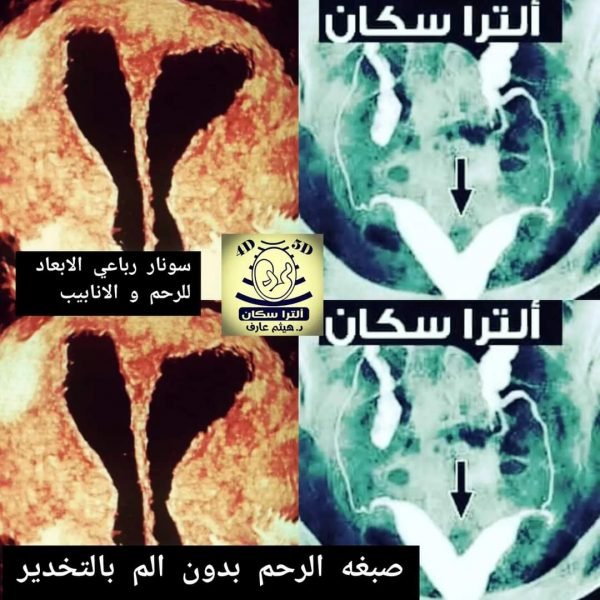 صبغه الرحم بالتخدير بدون الم مع السونار رباعي الابعاد الرحمي