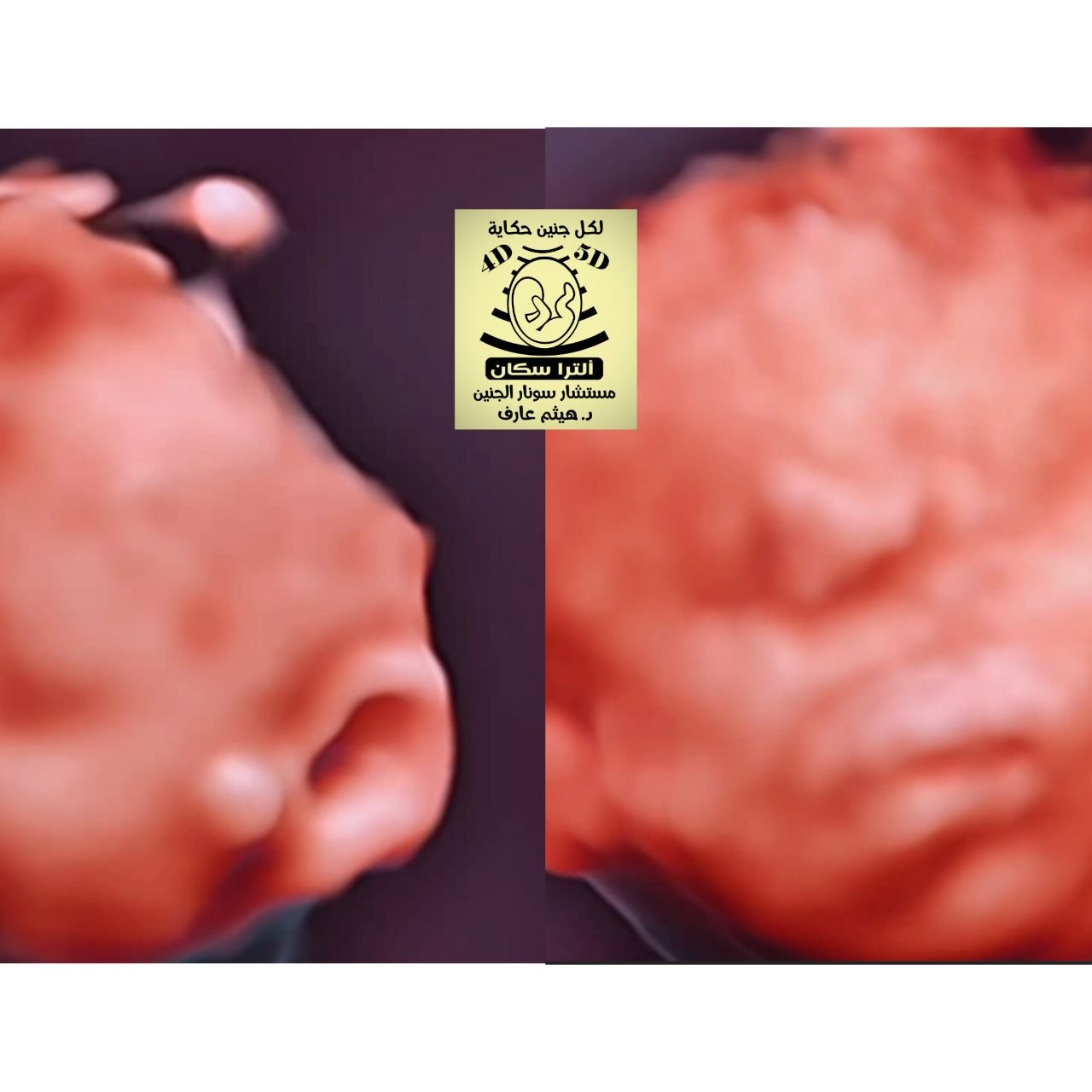 preauricular tag fetal ultrasound