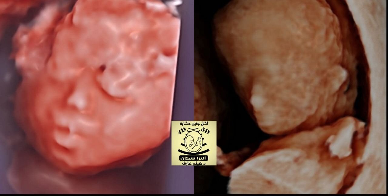 Cebocephaly fetal ultrasound
